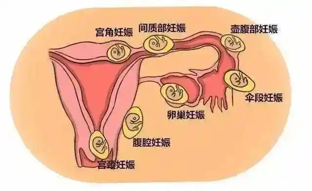 肚子痛竟是子宮外孕！了解子宮外孕診斷與治療